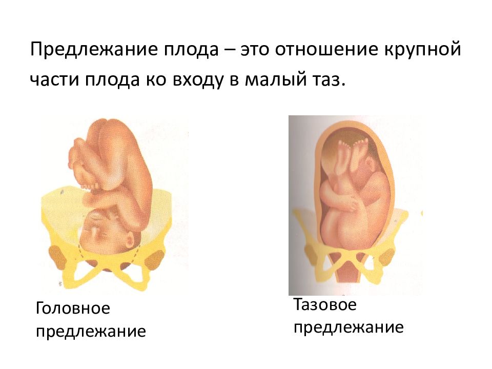 Предлежание плода картинки