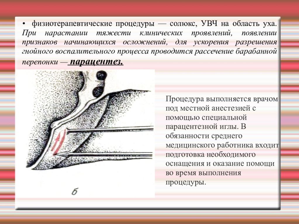 Парацентез барабанной перепонки. Острый Гнойный отит парацентез. Места парацентеза барабанной перепонки. Средний отит парацентез.