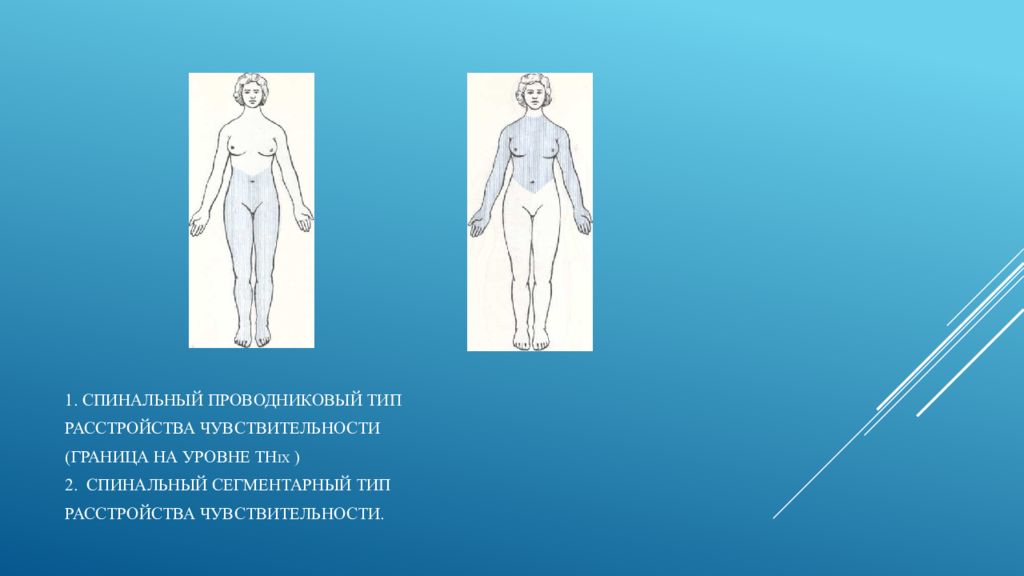 Сегментарный тип расстройства. Проводиниковое Тип расстройства чувствительности. Спинальный проводниковый Тип расстройства чувствительности. Спинально проводниковый Тип нарушения чувствительности. Проводниковый Тип нарушения.