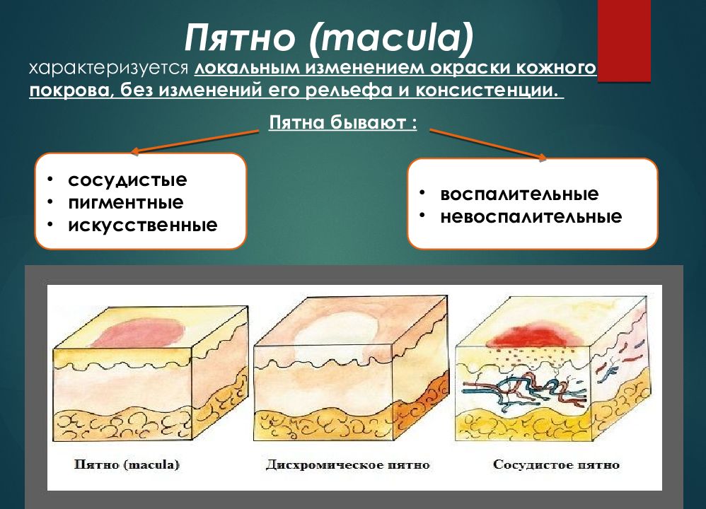 Окраска кожных покровов. Сосудистые невоспалительные пятна. Местное изменение кожи.