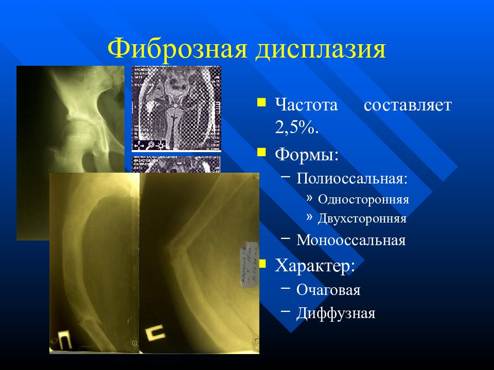 Очаговый характер. Полиоссальная фиброзная дисплазия. Полиоссальная форма фиброзной дисплазии. Монооссальная форма фиброзной дисплазии. Фиброзная дисплазия монооссальная кт.