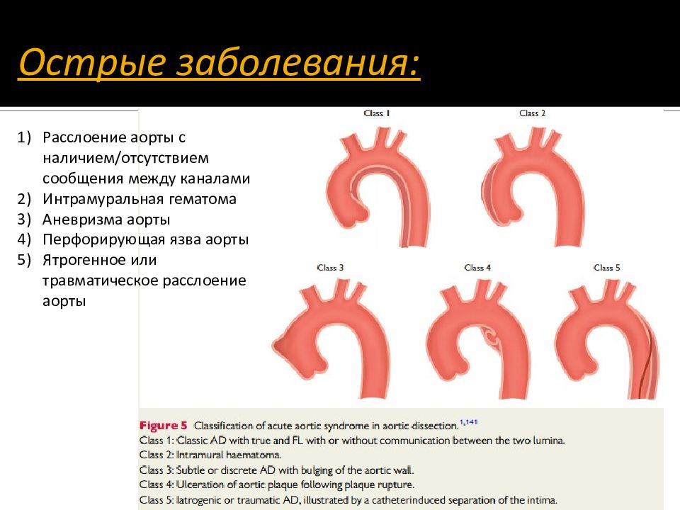 Аневризмы аорты презентация