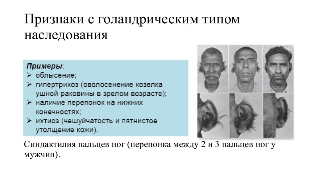 Сцеплен с y хромосомой. Голандрический Тип наследования. Голандрическое наследование признаков. Голандрический Тип наследования заболевания. Y-cцепленный (голандрический) Тип наследования.