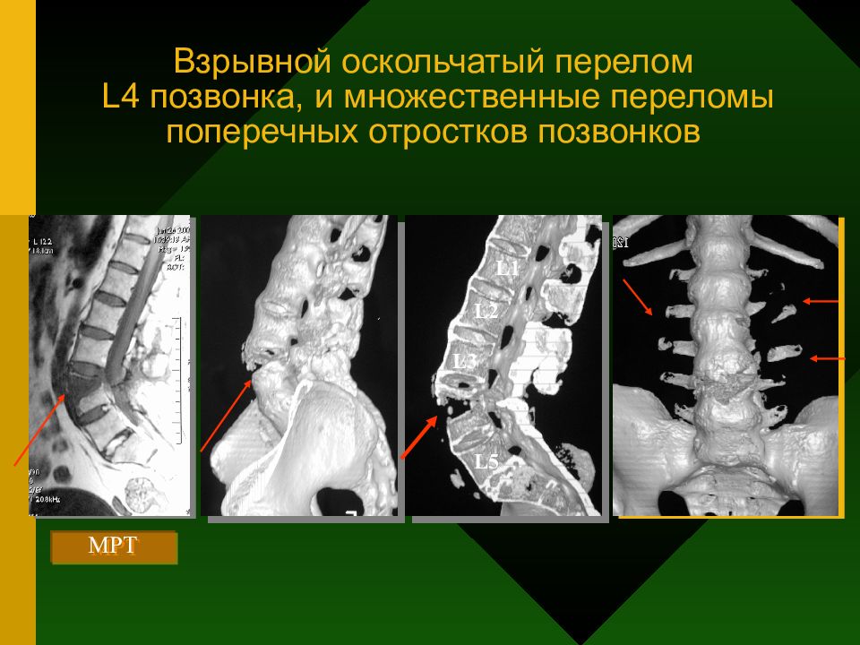 Оскольчатый перелом позвонка