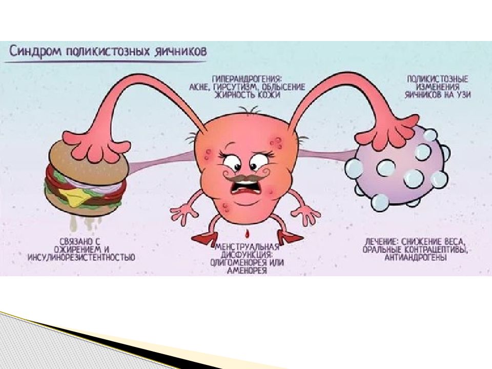 Лечение поликистоза яичников. Клинические проявления СПКЯ. Синдром поликистозных яичников симптомы. Клинические симптомы СПКЯ.