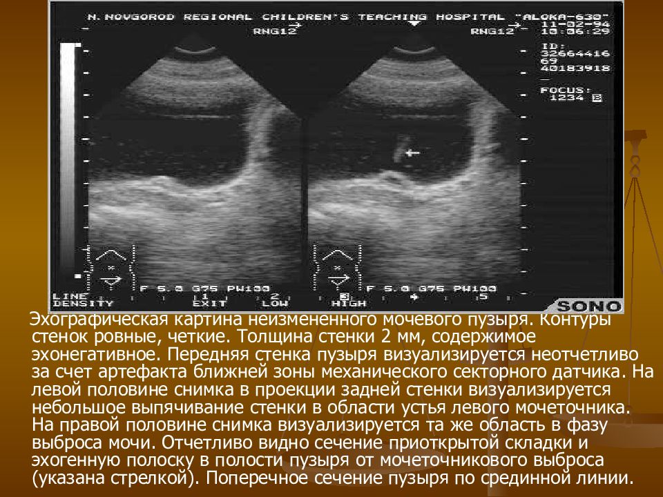 Узи почек и мочевого пузыря презентация