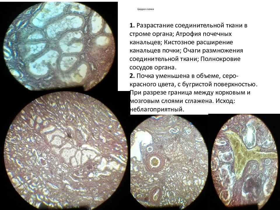 Разрастание ткани. Соединительная ткань в Кале микроскопия. Разрастание соединительной ткани. Разрастание соединительной ткани в почке.