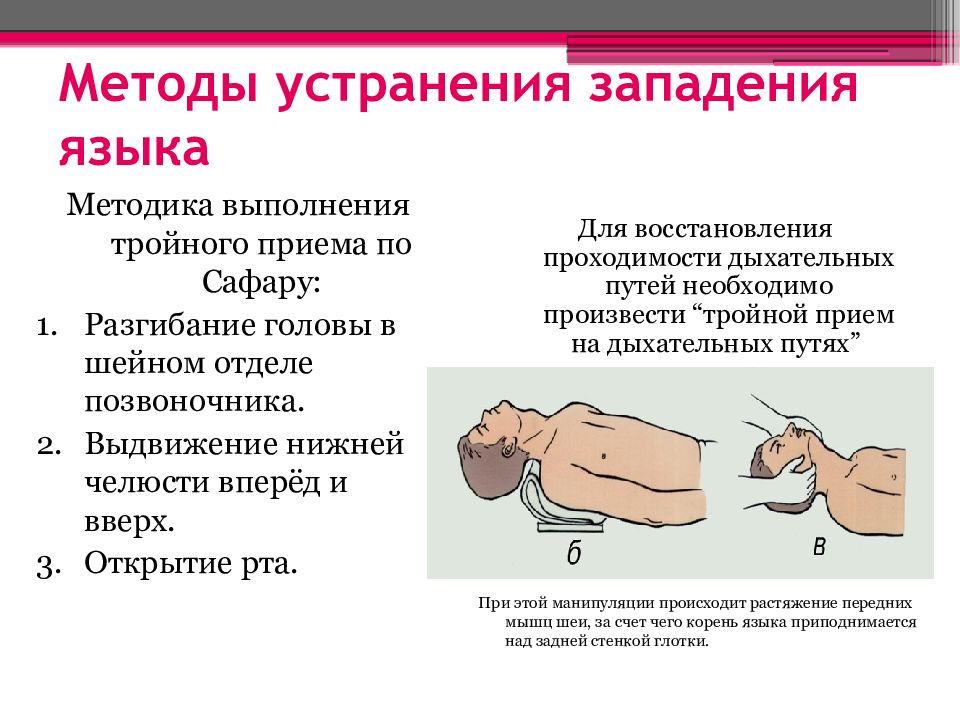 Что делает прием. Профилактика западения языка. Методы устранения западения языка. Западение языка первая помощь. Методика выполнения тройного приема Сафара.