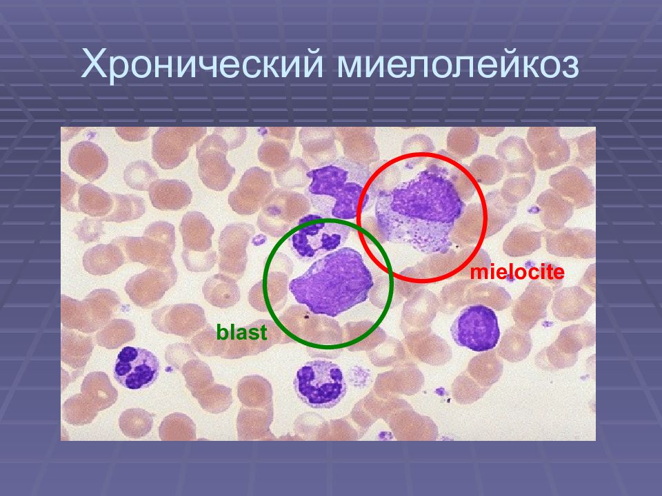 Хр миелолейкоз картина крови