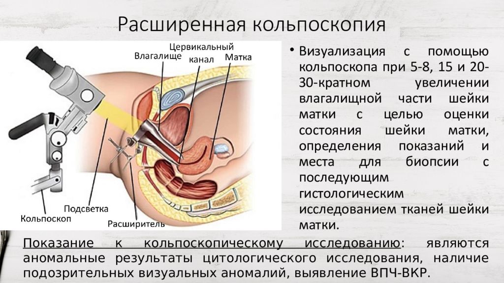 Расширенная кольпоскопия матки