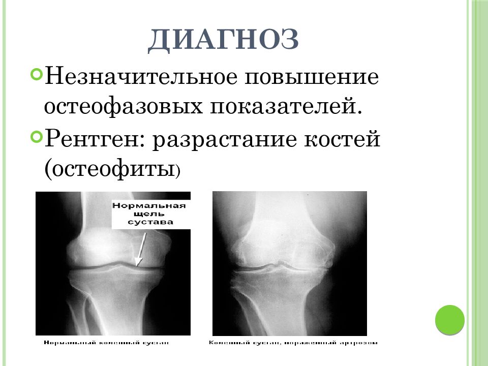 Незначительное повышение. Разрастание остеофитов. Костные разрастания на рентгене. Остеофит кости рентген.