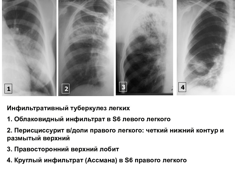 Туберкулез легких карта вызова