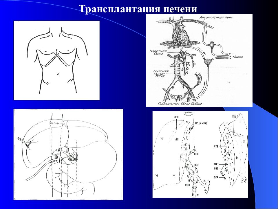 Портальная гипертензия хирургия презентация