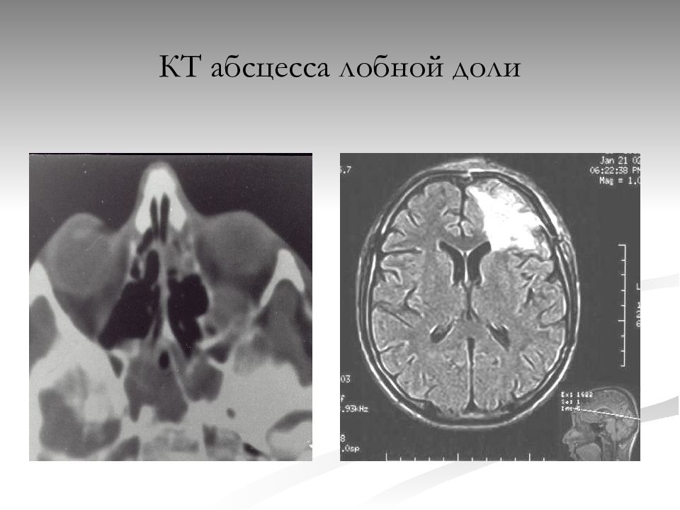 Отогенный абсцесс мозга. Субдуральный абсцесс кт. Отогенные абсцессы головного мозга. Субпериостальный абсцесс орбиты кт. Ретробульбарный абсцесс кт.