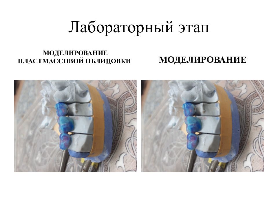 Лабораторные этапы изготовления пластмассовой коронки. Моделирование пластмассовой коронки. Цельнолитые с пластмассовой облицовкой. Цельнолитой мостовидный протез клинико лабораторные этапы. Этапы изготовления пластмассовых коронок.