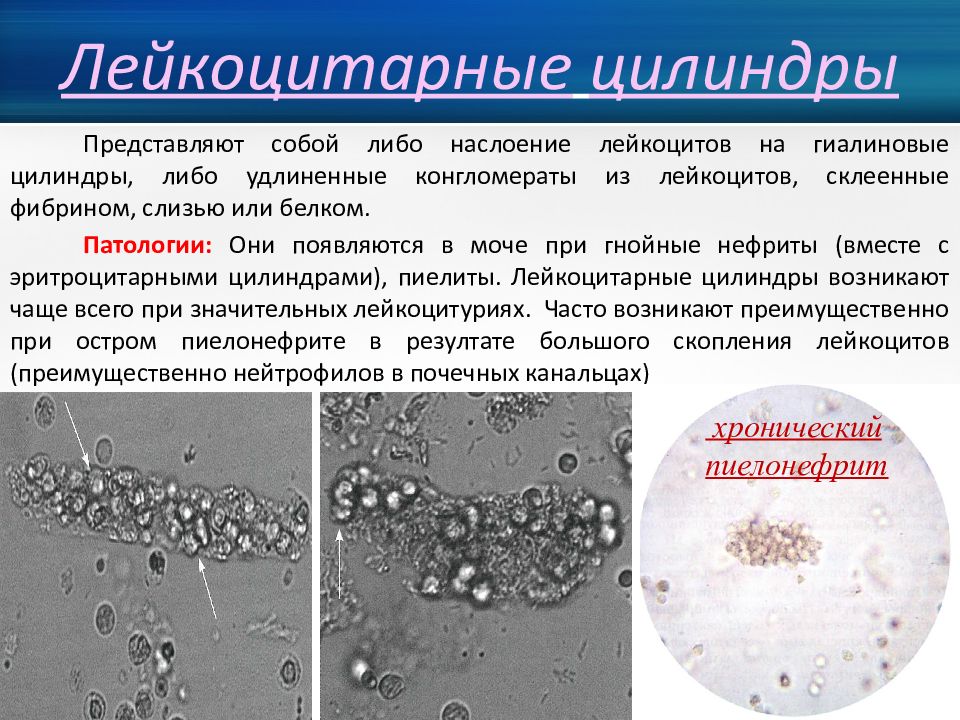 На наличие цилиндров при микроскопии осадка мочи указывает картина