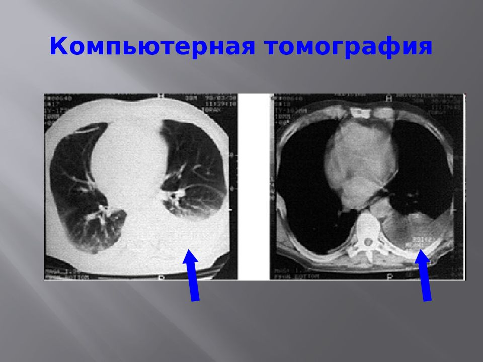 Гидроторакс на кт. Туберкулезный плеврит кт. Осумкованная жидкость в плевральной полости кт. Осумкованный плеврит на кт.