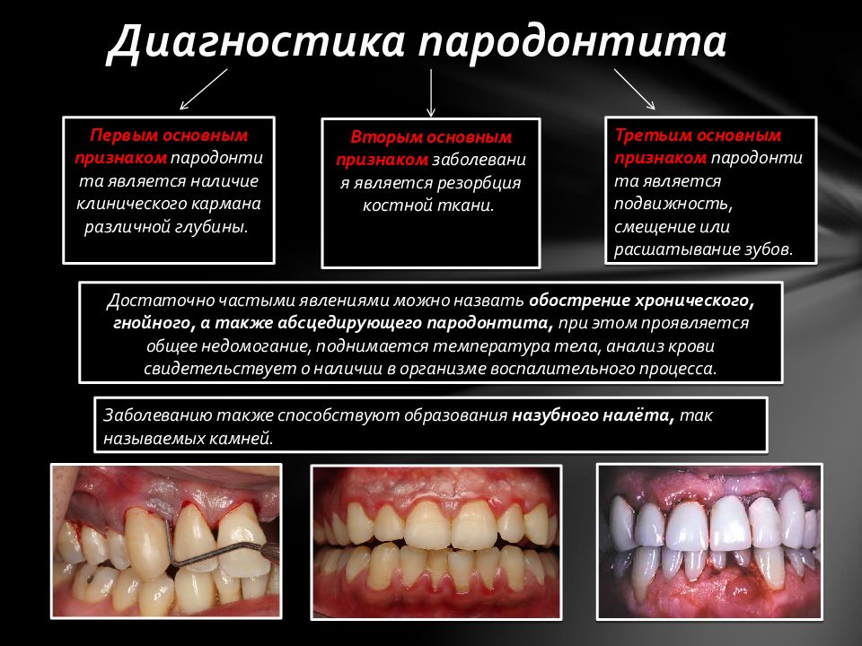 Схема лечения пародонтита