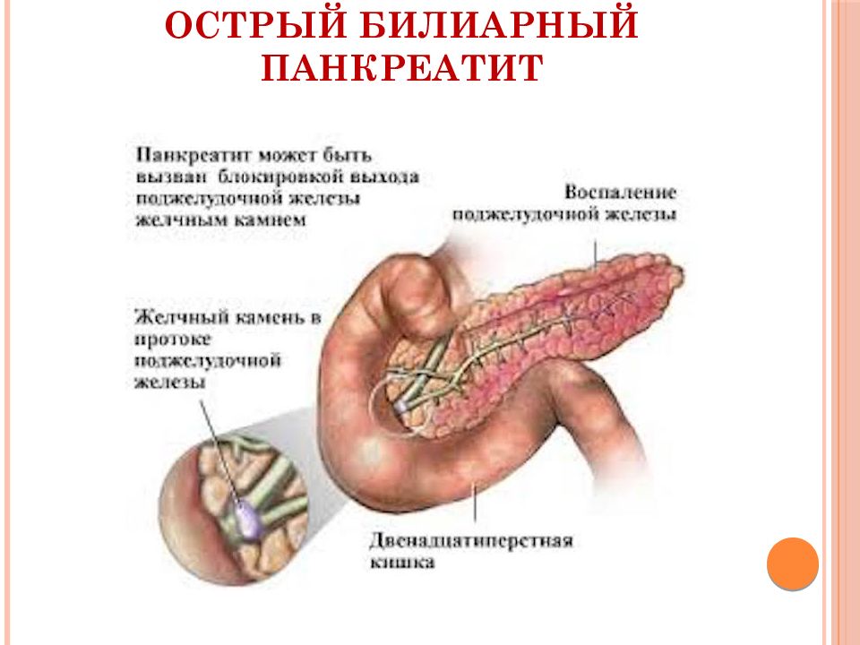 Хронический панкреатит рисунок