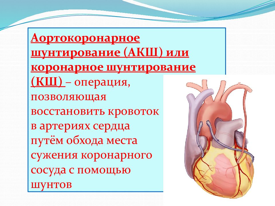 Что такое шунтирование сердца и сосудов. Аорта коронарное шунтирование. Аррто коронареое шунтирование. Порто коронарное шунтирование.