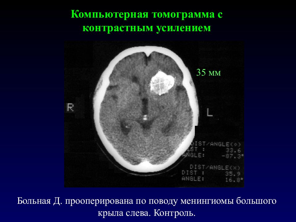 Контрастное кт. Кт с контрастным усилением. Контрастное усиление кт-изображения. Кальцинированная менингиома.