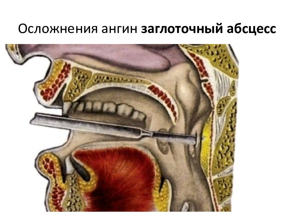 Заглоточный абсцесс