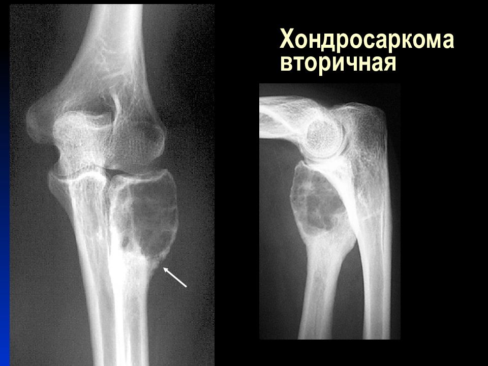 Рецидив кости. Хондросаркома кости рентген. Хондросаркома бедренной кости кт. Хондросаркома тазобедренного сустава. Центральная хондросаркома бедренной кости.