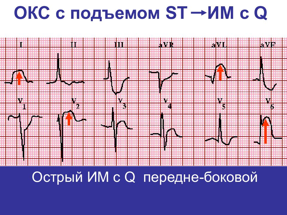 Повреждение миокарда без подъема st. Подъем сегмента St на ЭКГ. Окс c подъемом сегмента St ЭКГ. Инфаркт миокарда без подъема сегмента St ЭКГ. Инфаркт без подъема сегмента St на ЭКГ.