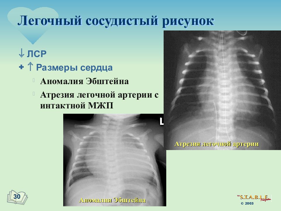 Легочный сосудистый рисунок. Атрезия легочной артерии рентген. Аномалия Эбштейна рентген. Артещия легочнрй артерии. Атрезия легочной артерии классификация.