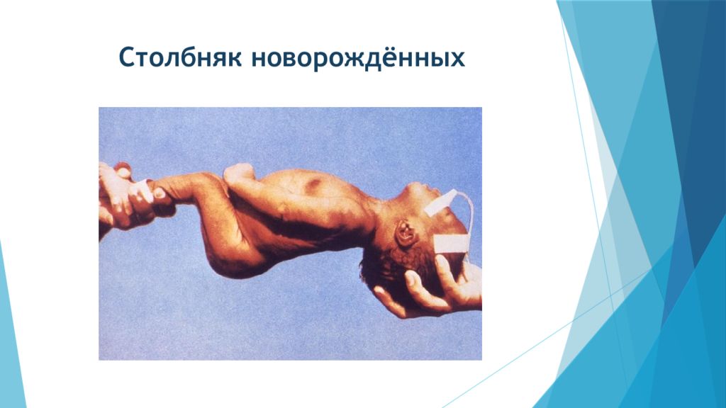 Столбняк — презентация