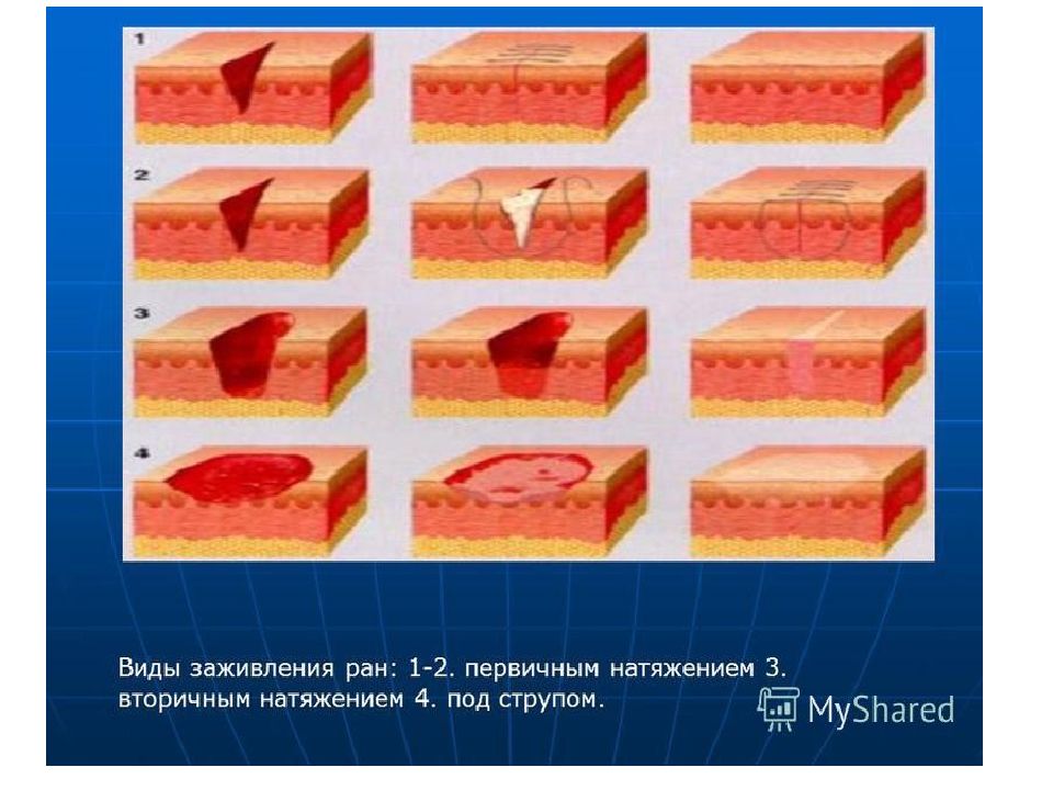 Виды лечения раны. Заживление РАН первичным и вторичным натяжением. Этапы заживления РАН вторичным натяжением. Раневая инфекция кожи и мягких тканей. Процесс заживления РАН мягких тканей.