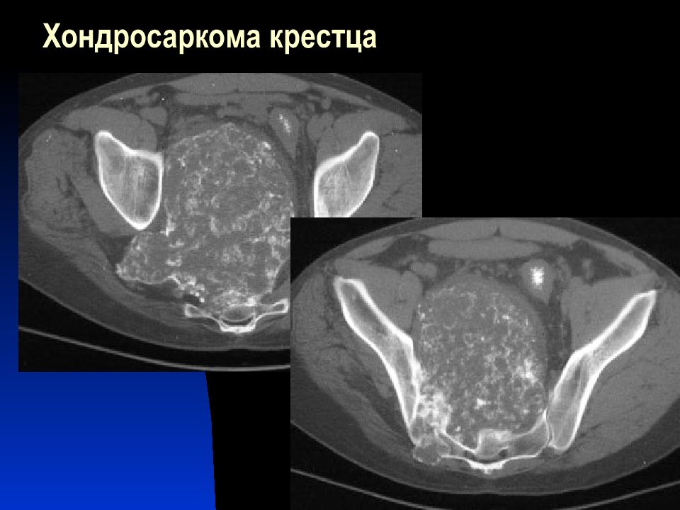 Хондросаркома. Фиброзная дисплазия крестца кт. Хондросаркома подвздошной кости на кт. Хондросаркома крестца. Хондросаркома рентген.