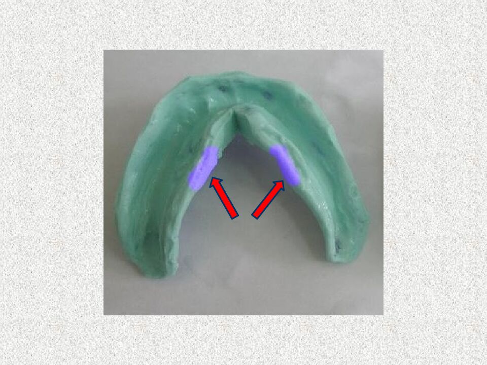 Funksional otisklar uchun individual qoshiqchalar