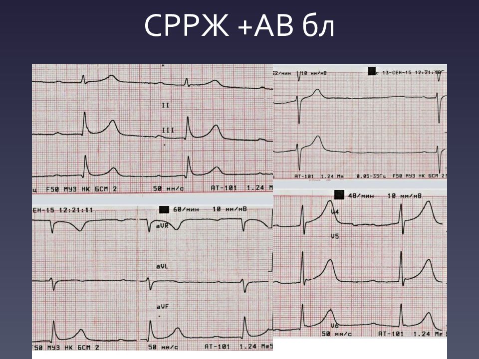 Снижение реполяризации нижней стенки. СРРЖ на ЭКГ. Элевация сегмента St на ЭКГ. Ранняя реполяризация на ЭКГ. Элевация интервала St.