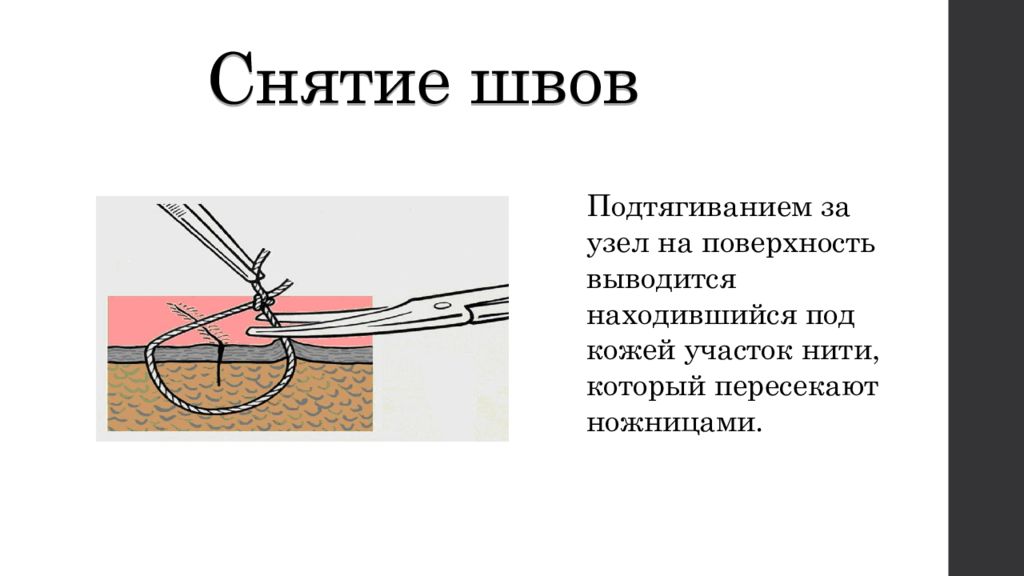 Как убирают швы. Снять швы в домашних условиях.