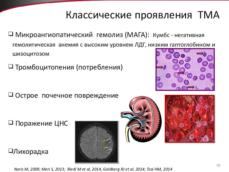 Что такое микроангиопатия. Диагностические критерии тромботических микроангиопатий. Микроангиопатическая анемия. Тромбоцитарная микроангиопатия. Анемия при микроангиопатии