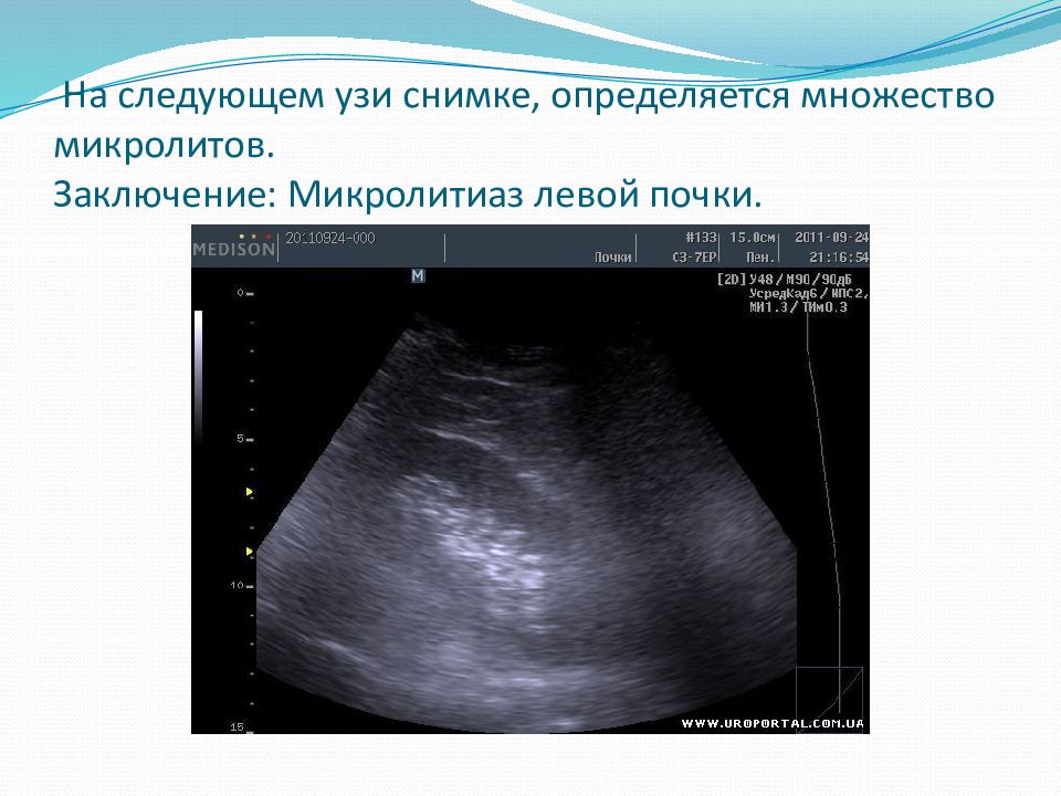 Микролиты в почках что это такое. Микролиты в почках на УЗИ. Микролитиаз почек УЗИ. Микролитиаз обеих почек УЗИ.