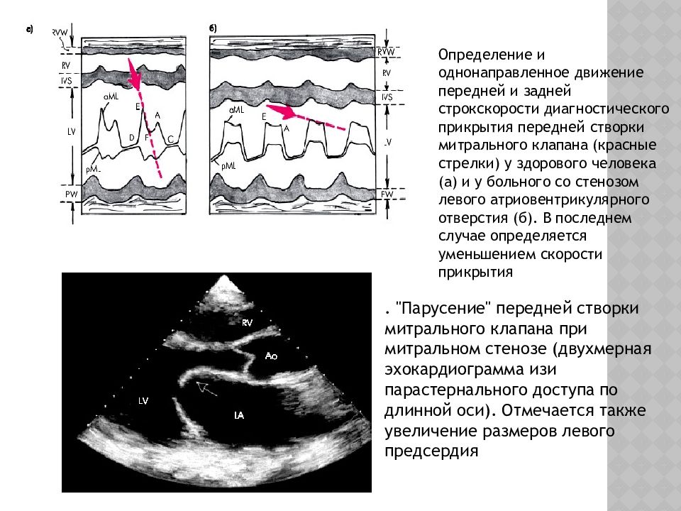 Противофаза клапана. Передняя створка митрального клапана на Эхо. Митральный стеноз ЭХОКГ. Переднесистолическое движение митрального клапана Эхо. Стеноз митрального клапана на УЗИ.