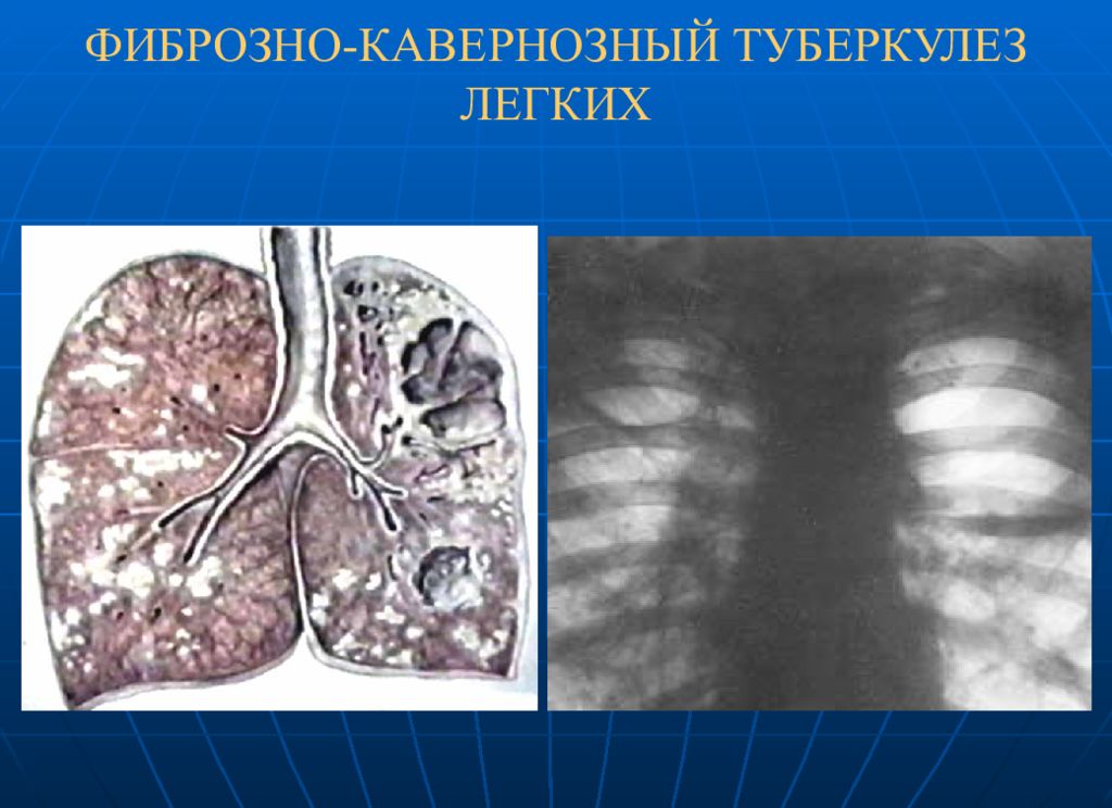 Картина фиброзных изменений. Цирротический туберкулез рентген. Поликавернозный туберкулез. Цирротический туберкулез кт. Фибринознокавернозный туберкулез.