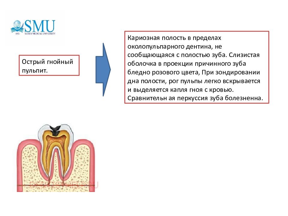 Полость острый. Пульпит зуба классификация острый. Этиология и патогенез пульпита. Этиология пульпита.