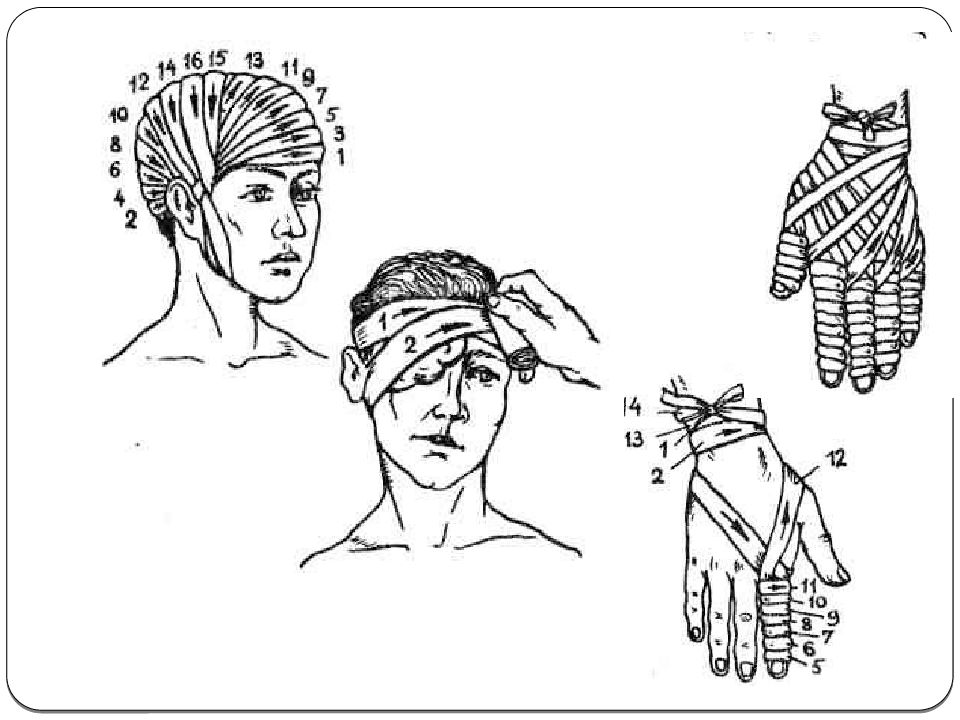 Как выглядит перевязка. Перевязка головной убор. Перевязки ОБЖ. Бинтовка шапочка. Как делать перевязку.
