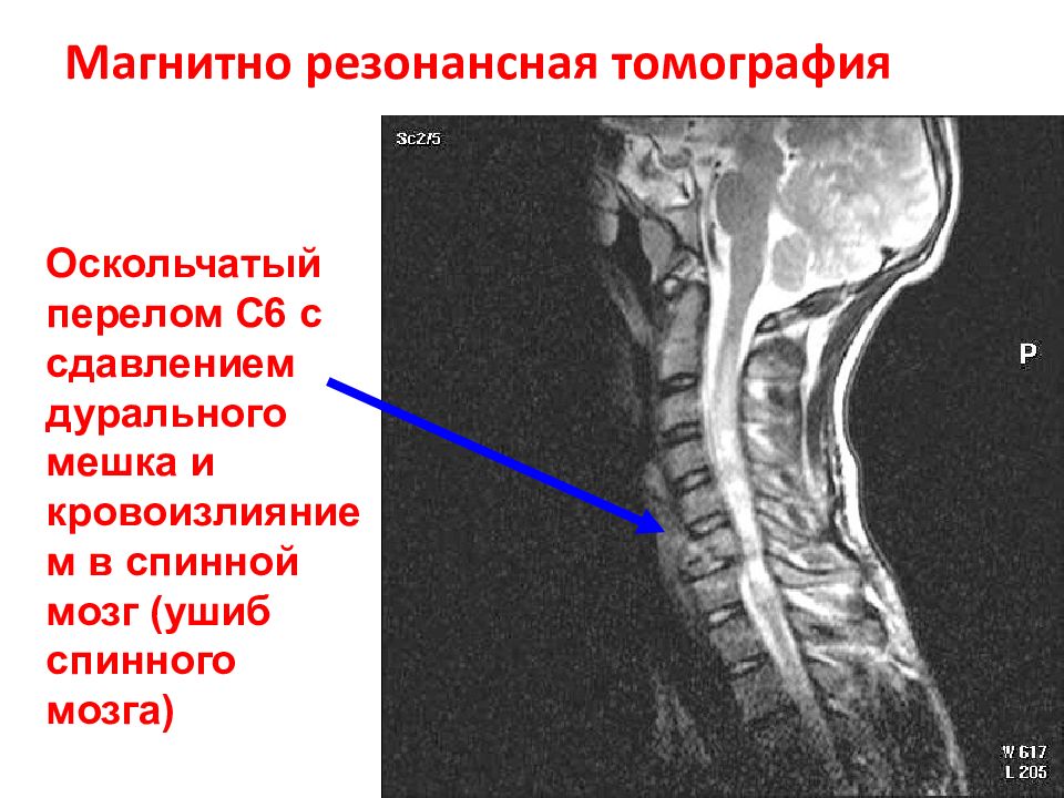 Гемангиома в позвонке фото