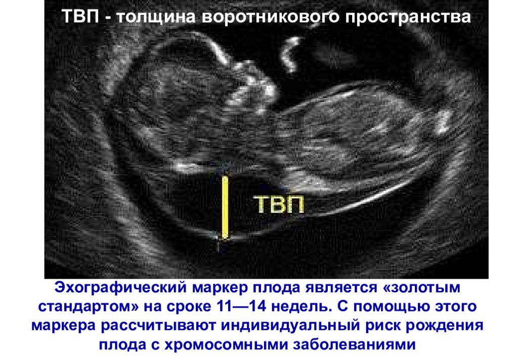 Толщина воротникового пространства