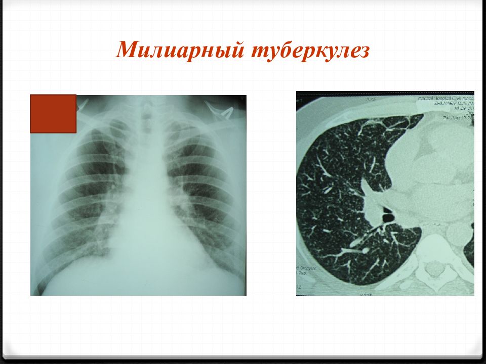 Милиарный туберкулез. Милиарный туберкулез легкого рентген. Острый милиарный туберкулез. Милиарный туберкулез фтизиатрия.