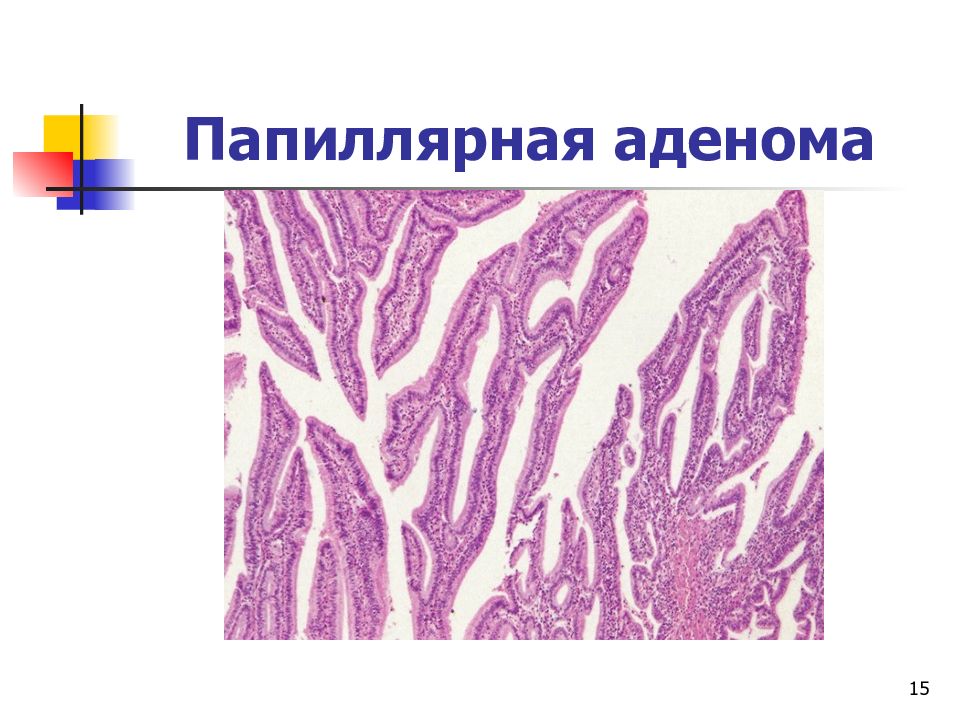 Микропрепарат аденокарцинома желудка рисунок