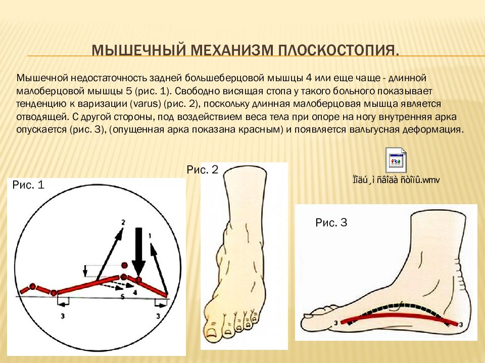 Продольное плоскостопие презентация