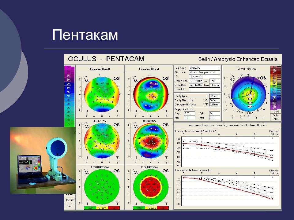 Презентация на тему кератоконус