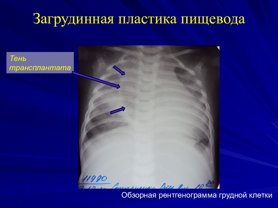 Впр пищевода