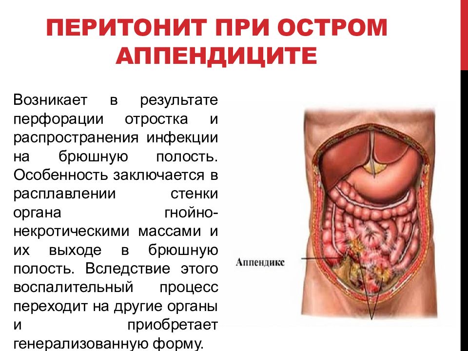 Перитонит у детей презентация