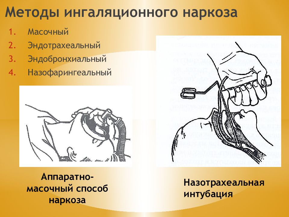 Проведение эндотрахеального наркоза. Ингаляционный наркоз эндотрахеальный. Методика эндотрахеального наркоза. Методика ингаляционной анестезии. Эндотрахеальный метод анестезии.